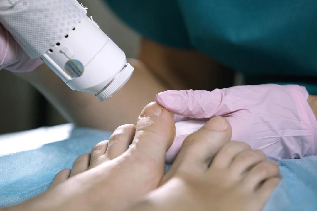 Women recieving a nail fungus removal treatment at Laser Care in Gravesend