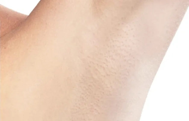 Armpit after laser hair removal at the Gravesend clinic showing no hair.