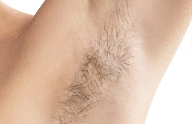 Armpit before laser hair removal gravesend, showing hair growth.