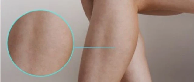 A leg after spider veins and thread veins have been removed, showing clear skin.