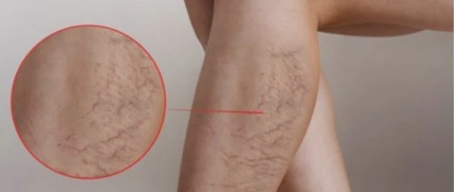 Spider veins and thread veins on a leg before laser removal.